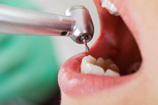 Best Chipped Tooth Repair Near Me  in Newkirk, OK